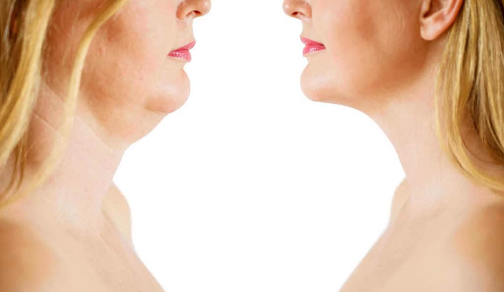 Double Chin treatment Wakefield before and after results