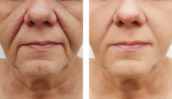 Learn more about Morpheus8 Treatment Wakefield today!
