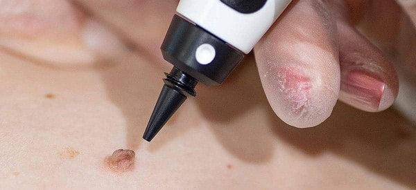 After Skin Tag Removal Wakefield