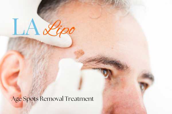 What Are the Most Effective Treatments for Age Spots Wakefield?