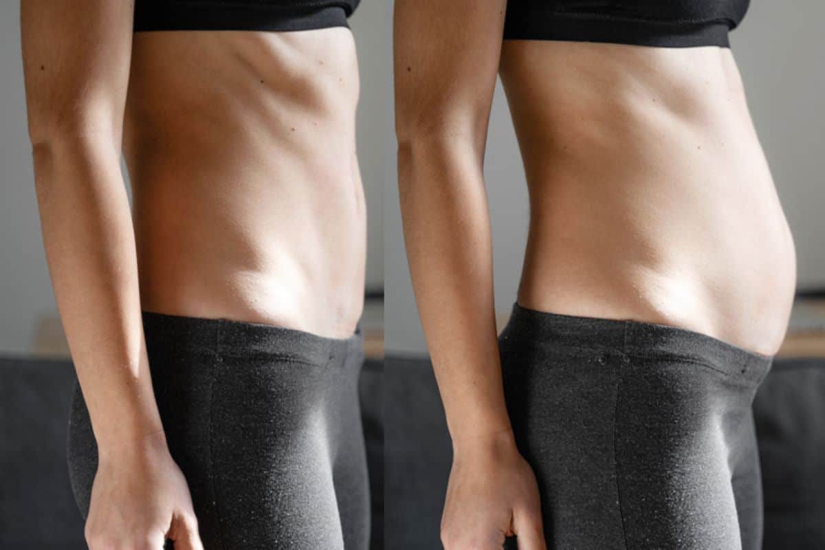 How long does diastasis recti take to improve Wakefield?