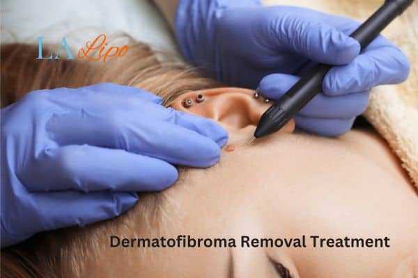 Dermatofibroma Removal Treatment Wakefield