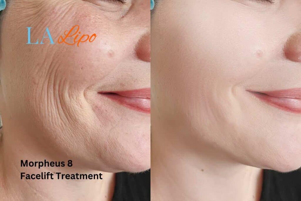 Morpheus8 Treatment Wakefield for flawless skin! Call us today!