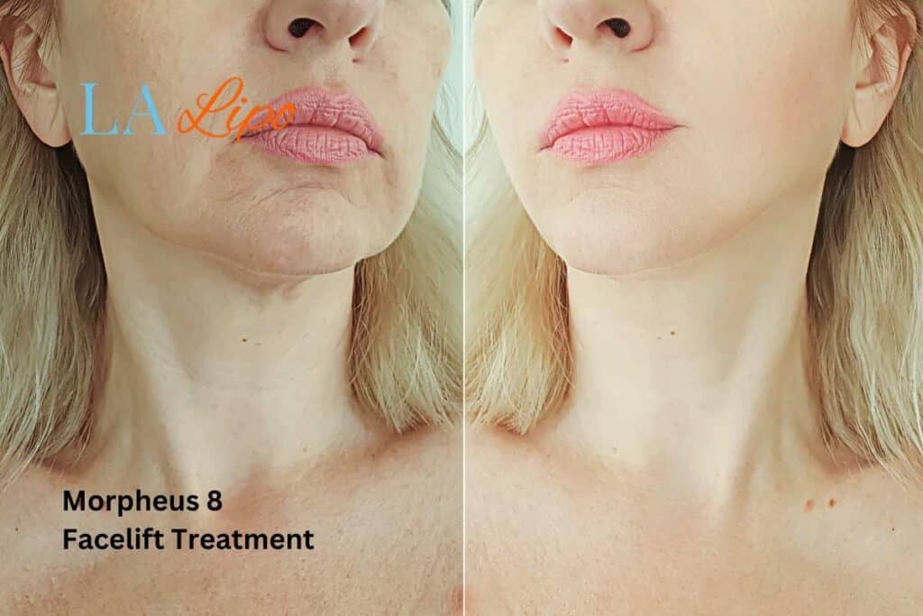 Turn back time with Morpheus8 Treatment Wakefield