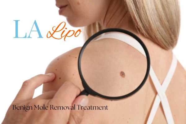 Why getting moles removed Wakefield can boost your confidence!