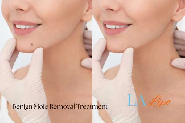 woman's before and after mole removal Wakefield results