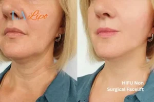 hi-fu for wrinkles Wakefield before and after results