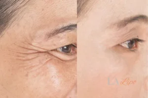 Before and after results of woman - HI-fu wrinkles reduction treatment Wakefield