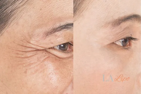 Before and after results of woman - HI-fu wrinkles reduction treatment Wakefield