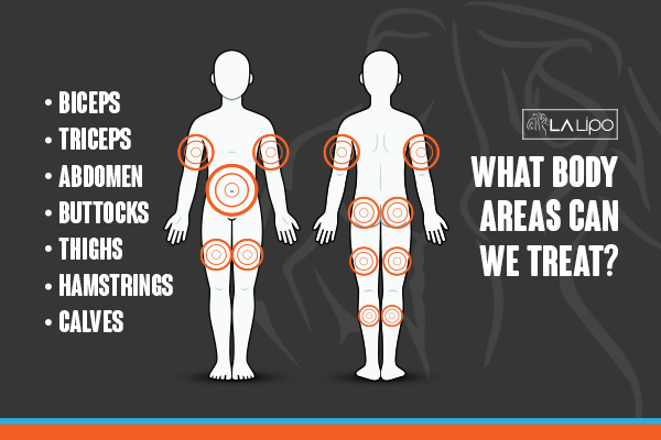 Graphic to show areas you can have LA-EMS Body Sculpting Wakefield treatment.