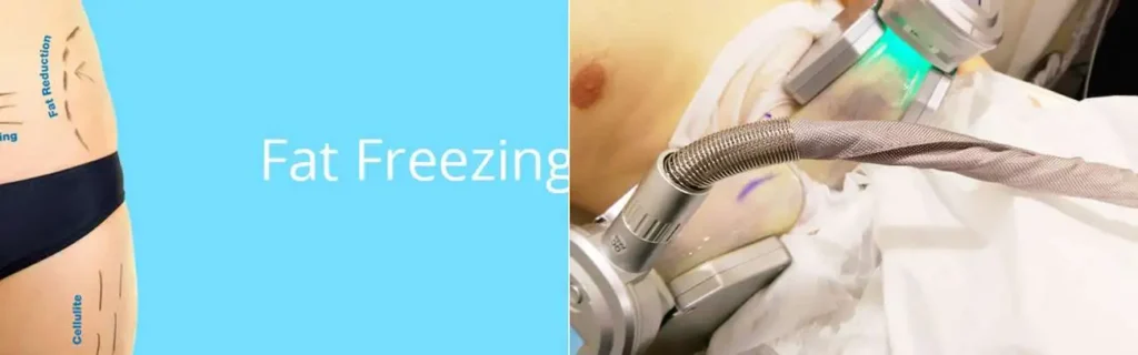 Fat freezing Wakefield on multiple areas of the body