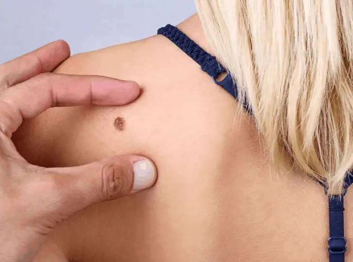 woman having mole removal Wakefield consultation before treatment.