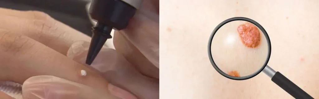 Cryopen for mole removal Wakefield - speak to our team today!