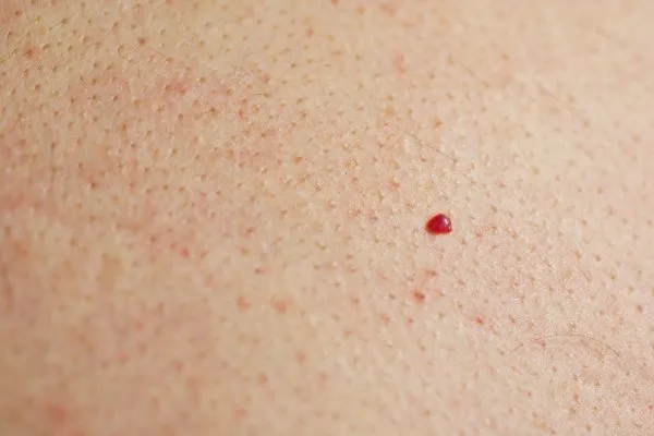 close up of a cherry angioma Wakefield