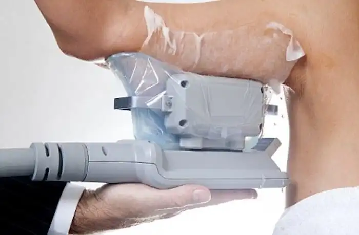 Picture of fat freezing Wakefield on the upper arms.