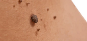 image of a skin tag Wakefield