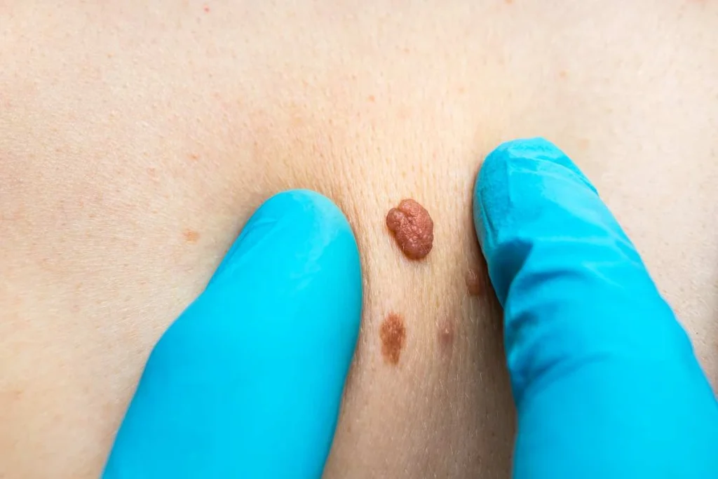 Consultant examining a skin tag Wakefield