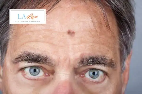Solar Lentigo Removal Wakefield image of man with mark on his forehead