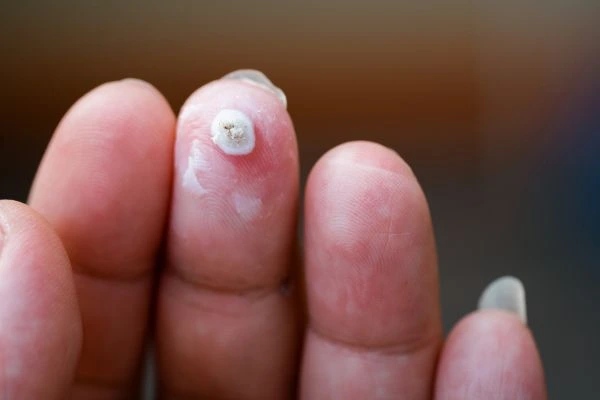 wart on person finger - cryotherapy to treat from LA LIPO Wakefield