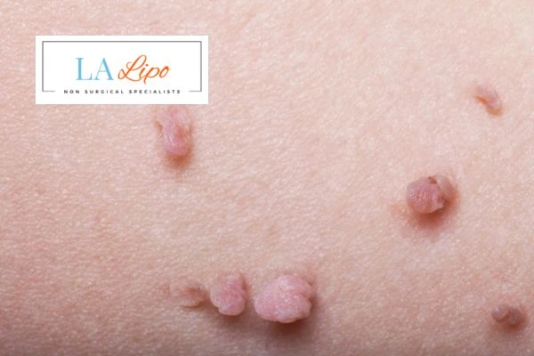 Does cryopen skin tag removal Wakefield hurt? Find out now call our team today!