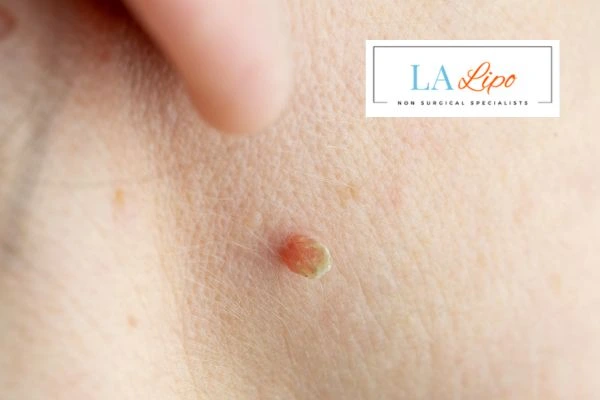 Book skin tag removal Wakefield today speak to our team now!