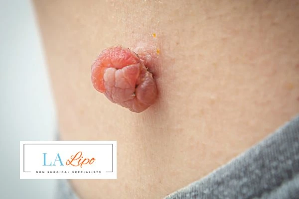 Interested in skin tag removal Wakefield? Concerned about the pain? Find out more today!