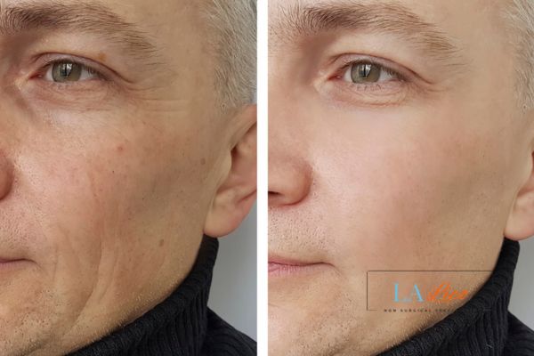 See the amazing results of Morpheus8 Treatment Wakefield!