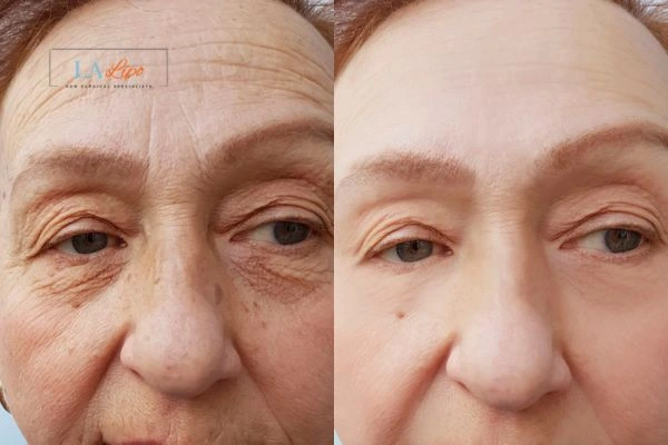 The powerful benefits of Morpheus8 Treatment Wakefield - Call Our team today!