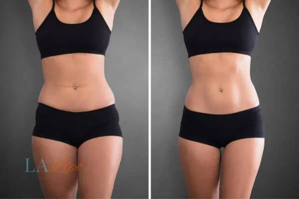 before and after results of non-surgical treatment to help a woman's body image and mental health Wakefield