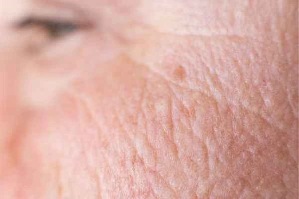 close up picture of a woman's face showing an age spot Wakefield
