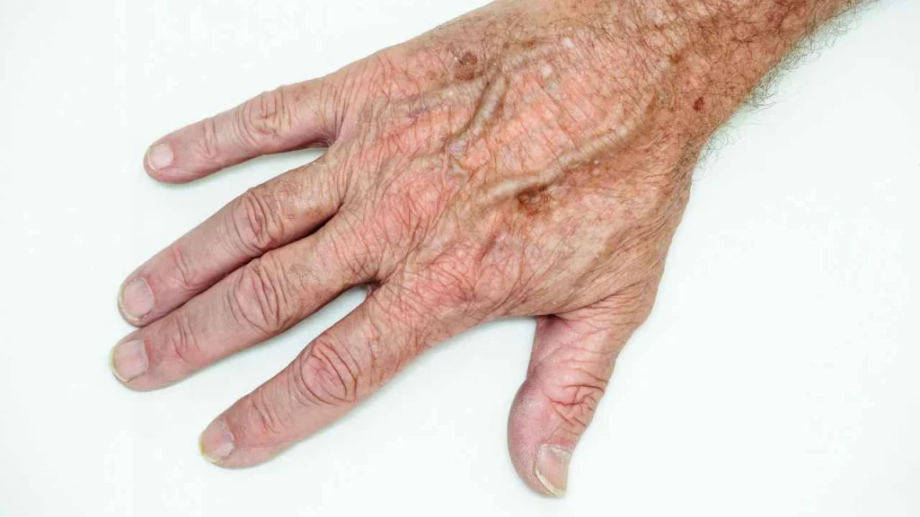Male hand showing age spot Wakefield