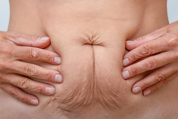 Should I Combine Diastasis Recti Treatment with Body Contouring for Better Results Wakefield?