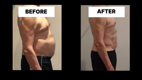 What Symptoms Can Diastasis Recti Cause in Men? Weak Core, Back Pain and Poor Posture Wakefield